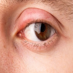 Eyelid Problems