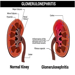Glomerulonephritis